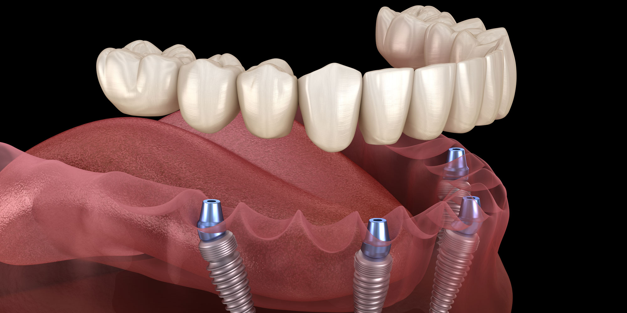 Factors affecting the success of dental implants